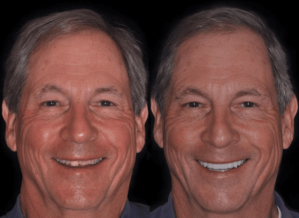 Smile Transformation
