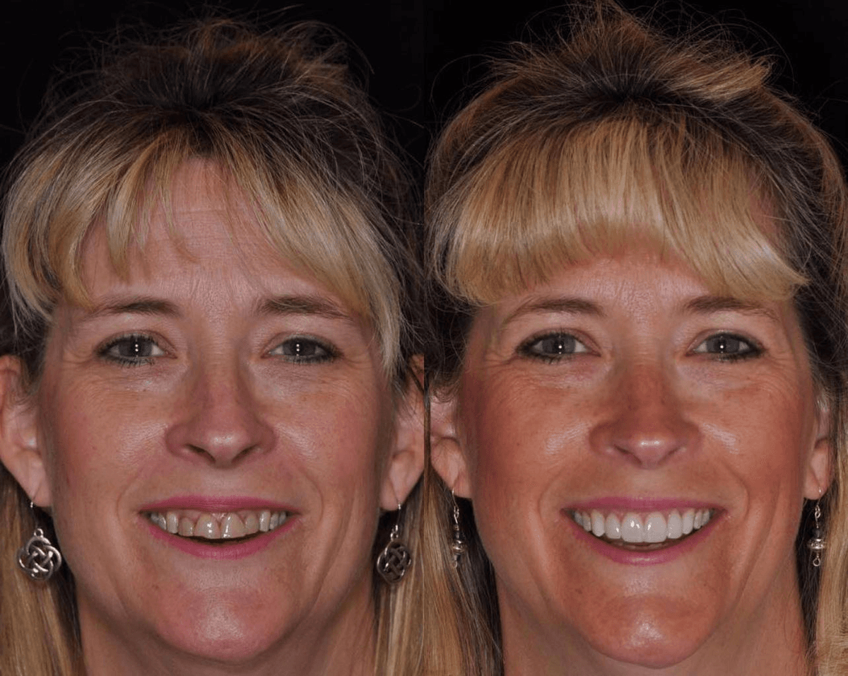 Smile Transformation