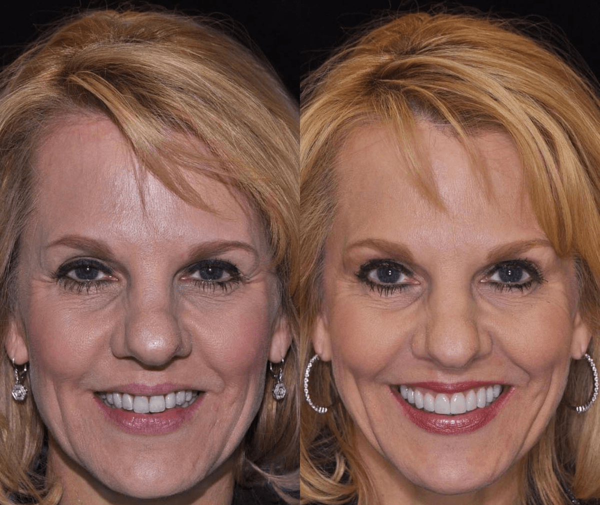 Smile Transformation