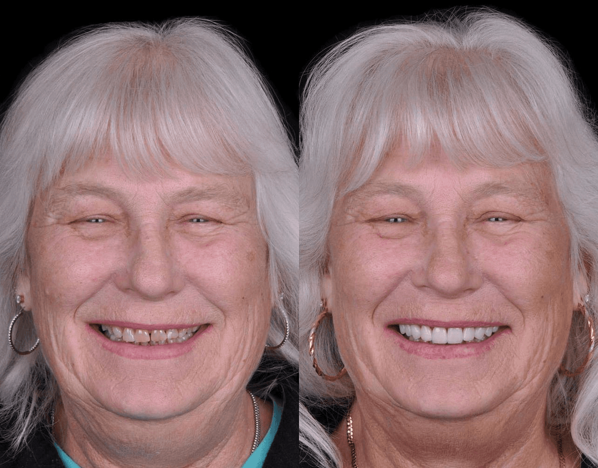 Smile Transformation